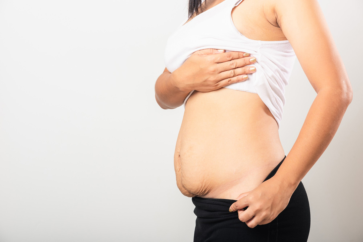 The Benefits Of Body Sculpting For Post-Pregnancy Body